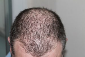 Les techniques efficaces contre la perte de cheveux